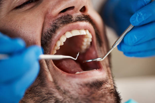 Best Emergency Dentist for Knocked-Out Tooth in Union City, CA