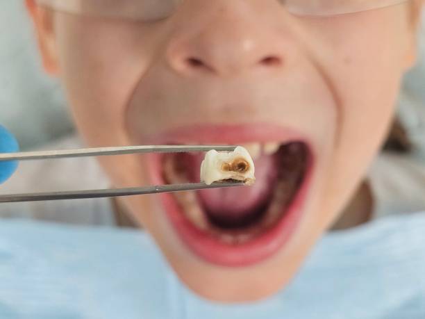 Best Broken or Cracked Tooth Emergency Dentist in Union City, CA